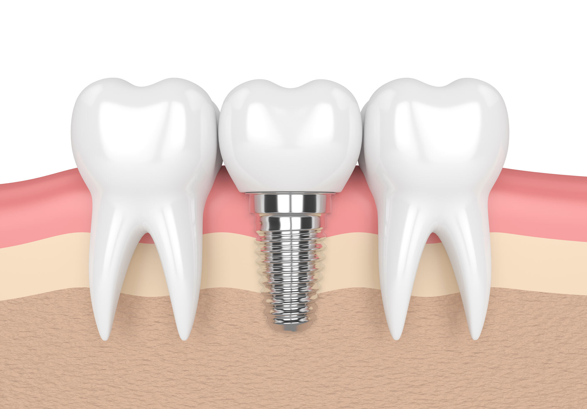 Dental Implants