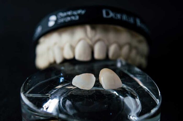 Why-Choose-Porcelain-Veneers Why Choose Porcelain Veneers