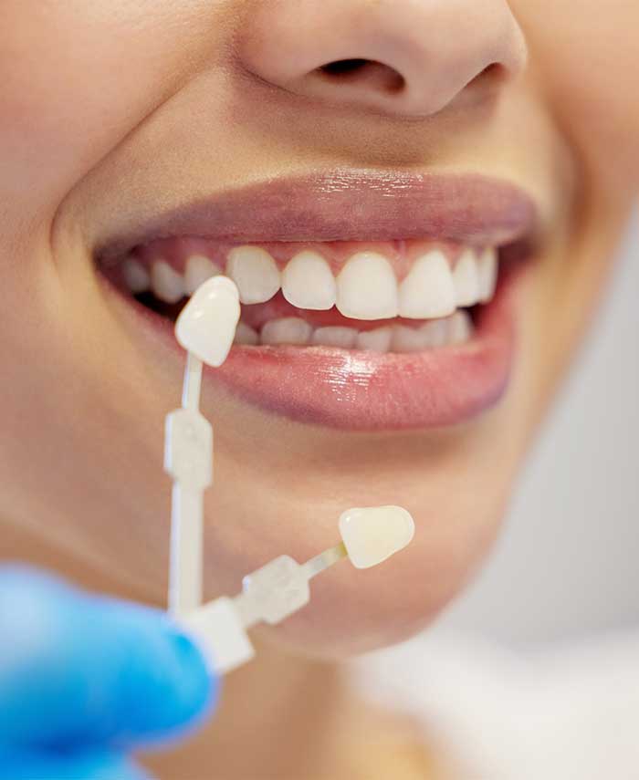 temporary-veneers Porcelain Veneers in Toronto