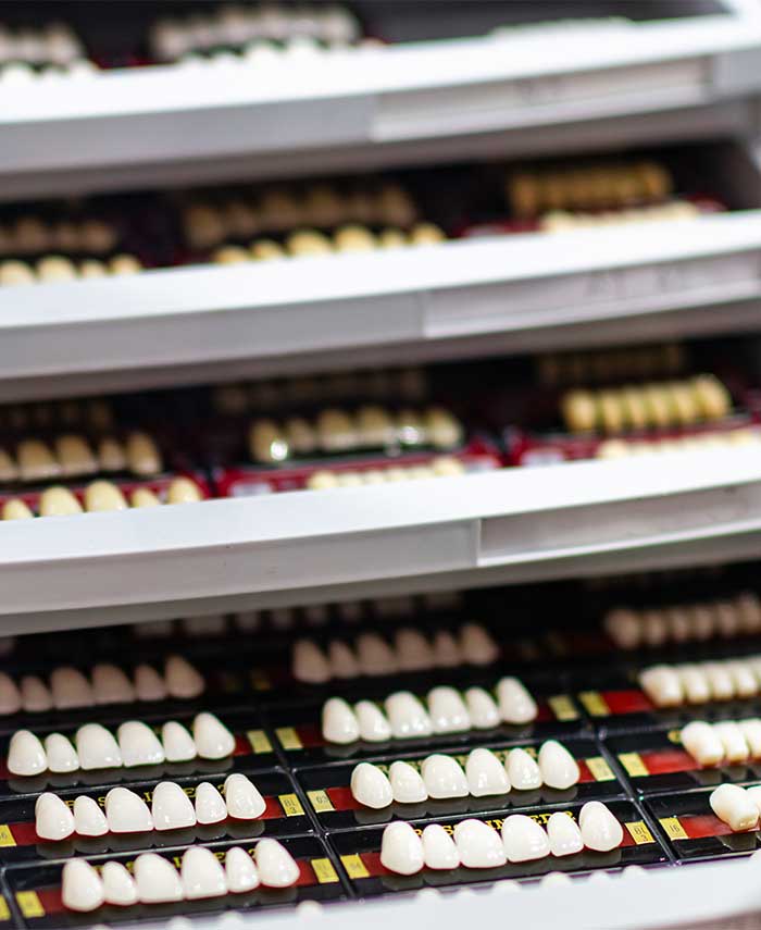 veneers-preparation Porcelain Veneers in Toronto